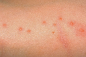 bed bug bites